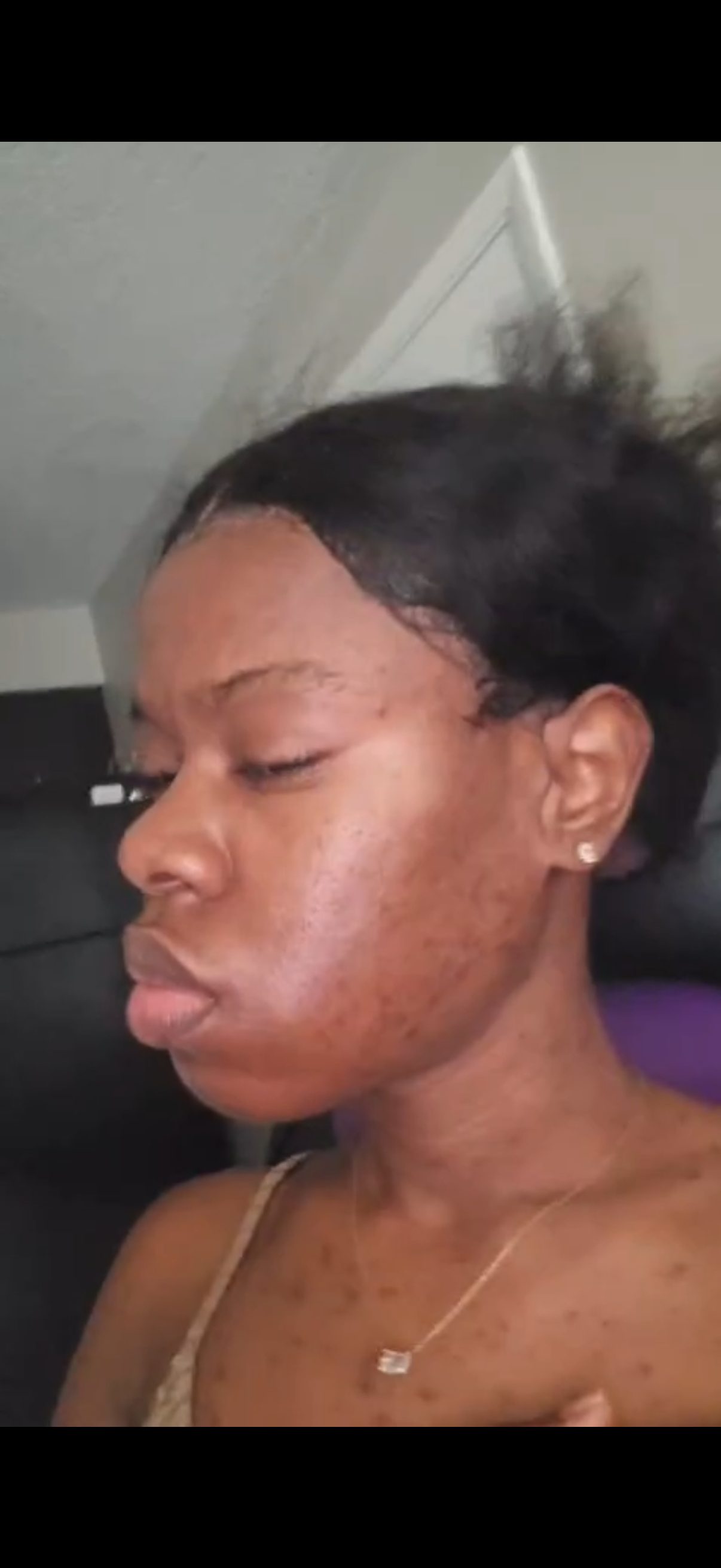 Acne Duo Pack
