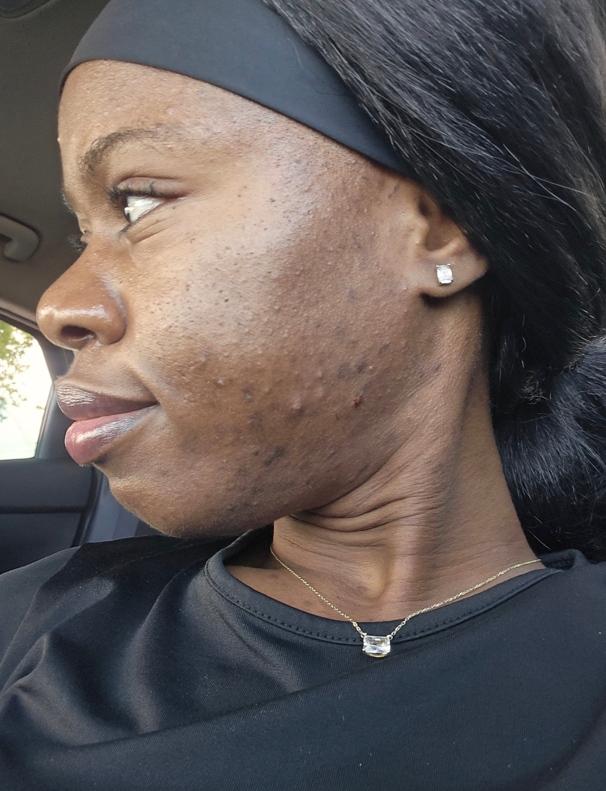 Acne Duo Pack